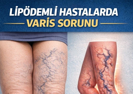 LİP&Ouml;DEMLİ HASTALARDA VARİS SORUNU: TEDAVİDE &Ouml;NCELİK NE OLMALI?